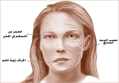  صحة و جمال العيون  - اعصاب العين - شلل العصب السابع